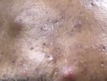 - Image of a cystic acne