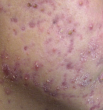 - Severe acne with acne scars