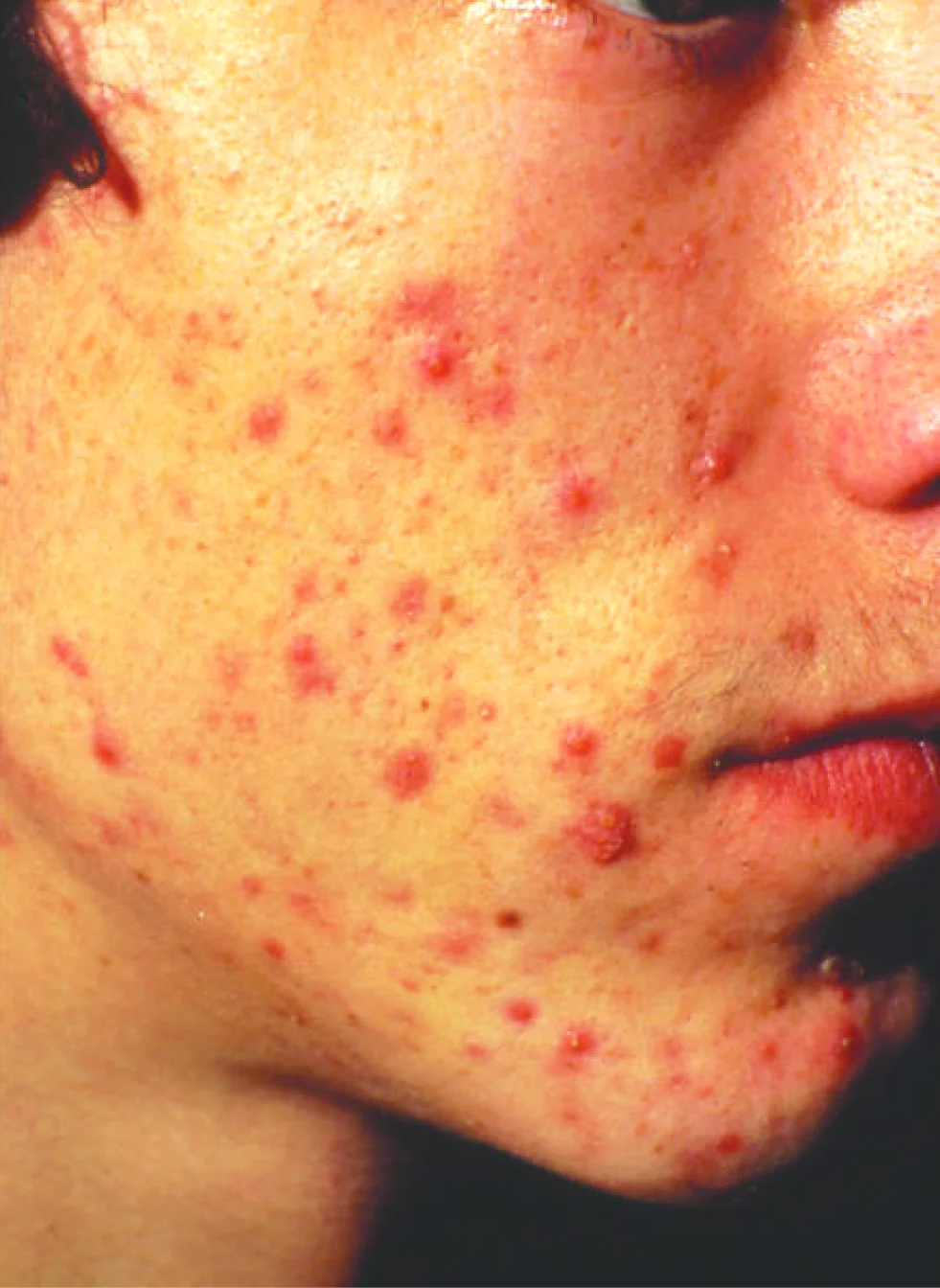 Severe acne must be consulted with a physician