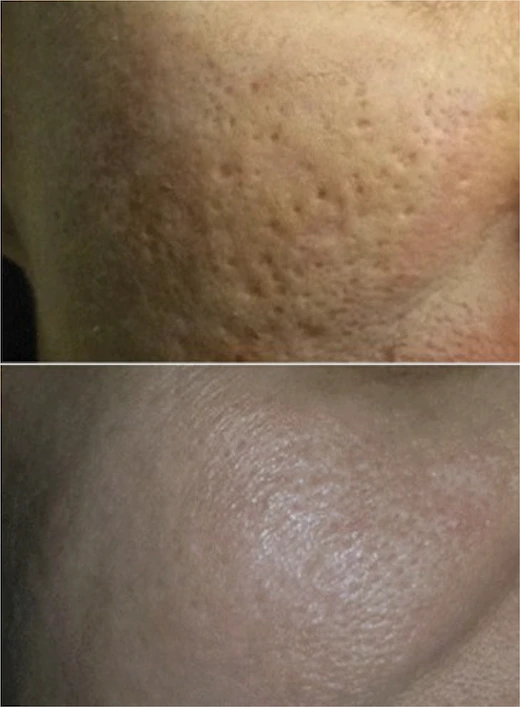 - Acne scars treated with dermabrasion and chemcial peels