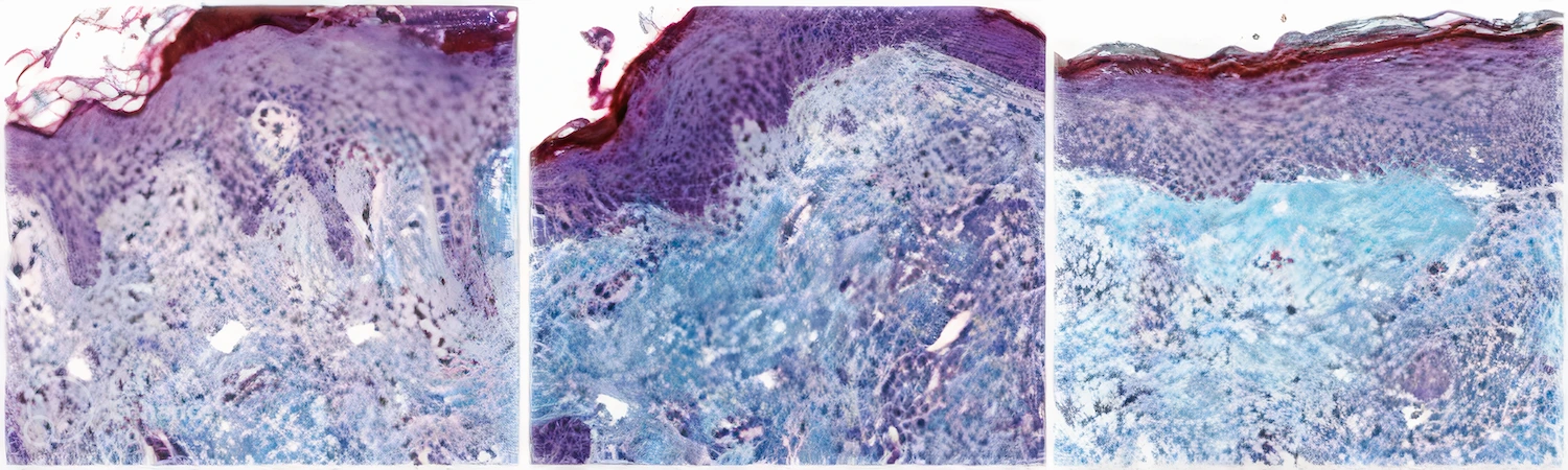 - How effective acne scar treatment improves appearance of acne scars