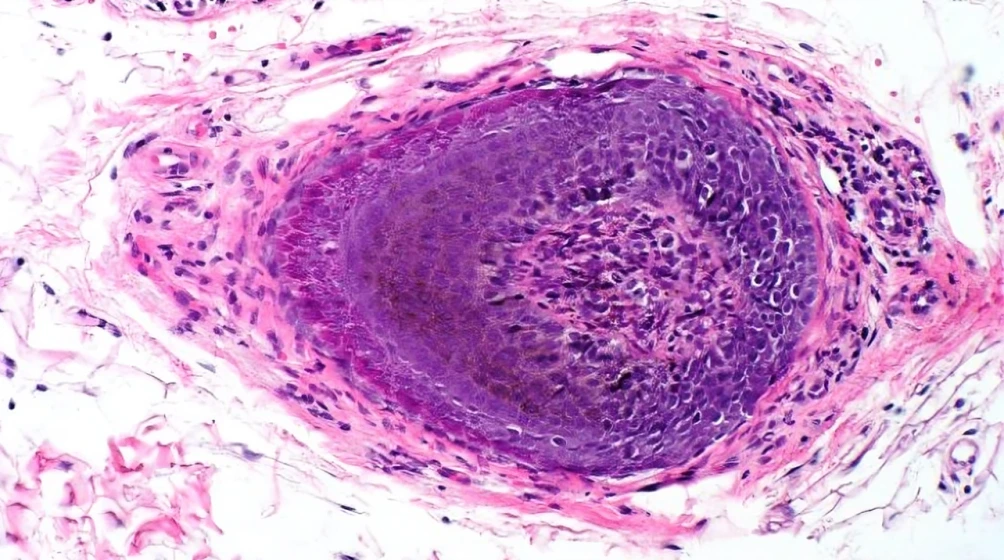 stress and alopecia areata