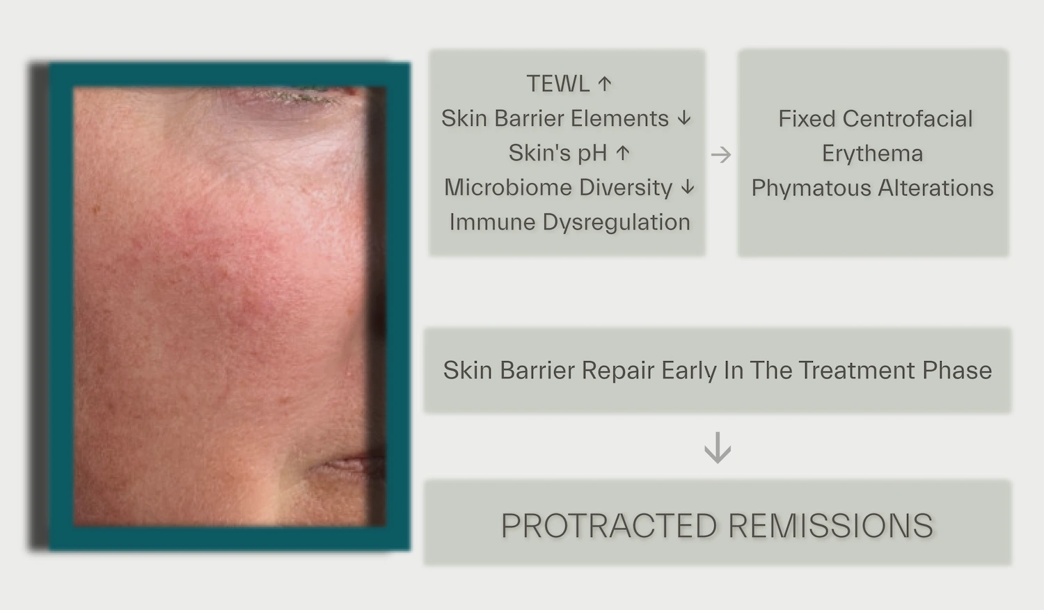 skin barrier deficiency in rosacea